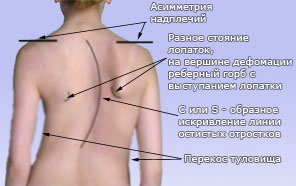 до какого возраста прогрессирует сколиоз. Смотреть фото до какого возраста прогрессирует сколиоз. Смотреть картинку до какого возраста прогрессирует сколиоз. Картинка про до какого возраста прогрессирует сколиоз. Фото до какого возраста прогрессирует сколиоз